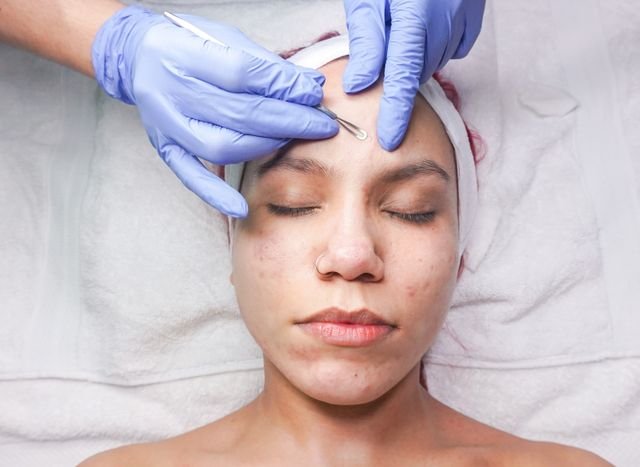 acne treatment Calgary
